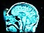 brain.nervous/stroke