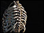 cancer/bone