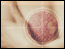 cancer/breast