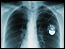 cancer/lung