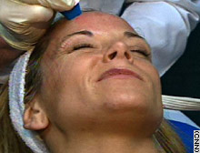Amy Otto, 33, undergoes the thermage procedure, which only takes a couple of hours.