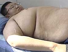The clinic says acupuncture helps reduce appetite and improve metabolism.